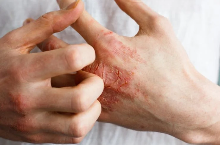 Eczema Treatment