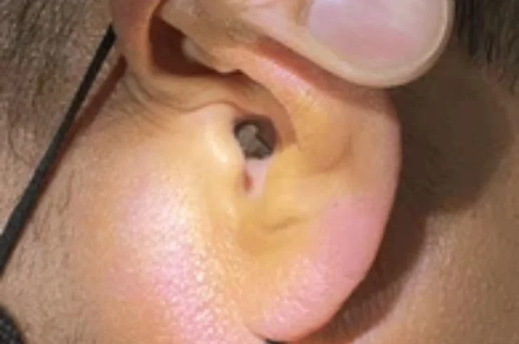 Foreign Body Removal Ear, Nose, Throat